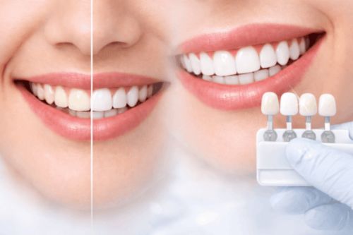 Smile Designing