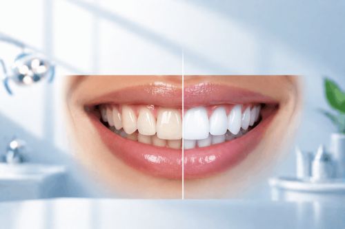 Teeth whitening